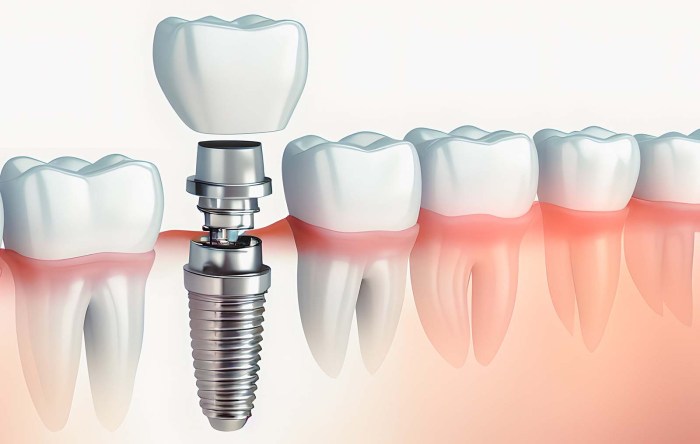 Dental Implants Cost in USA Full Guide 2026