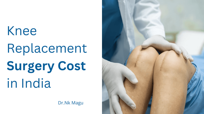 Cost of Knee Replacement Surgery in USA Insights and Costs